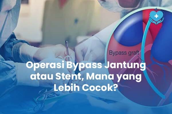 Operasi Bypass Jantung atau Stent Mana yang Lebih Cocok